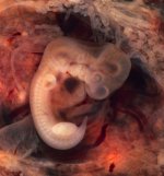 562px-Tubal_Pregnancy_with_embryo.jpg