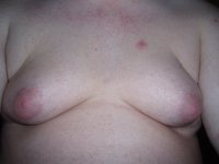 Gynecomastia_001.jpg